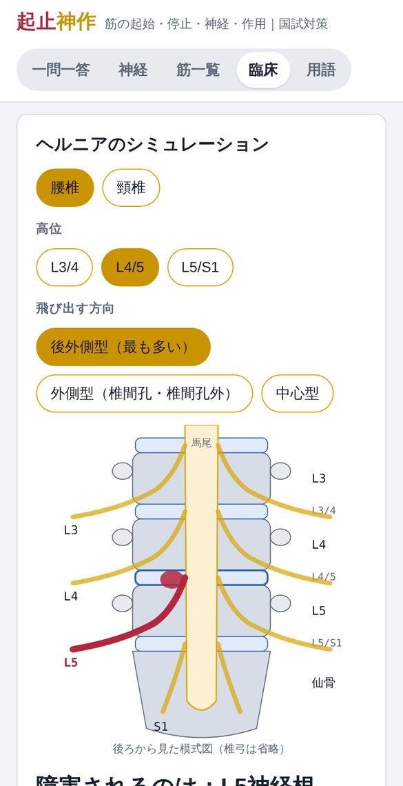 腰椎ヘルニアの模式図。L4/5の後外側型でL5神経根が赤く光る